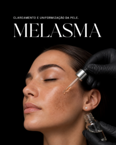 melasma_2